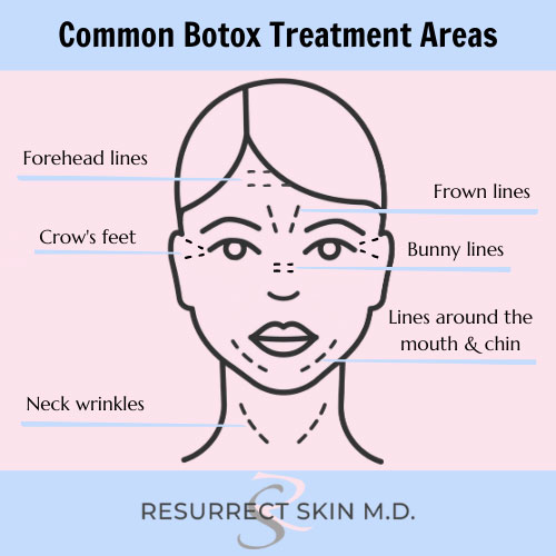 Botox dallas botox injections resurrect skin m d 